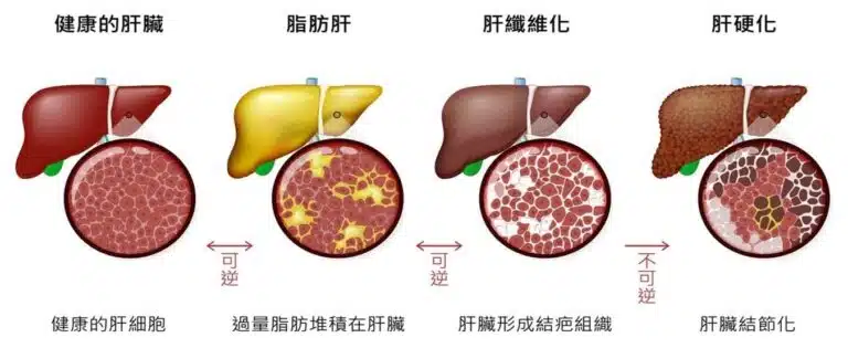 健康的肝臟 vs. 脂肪肝